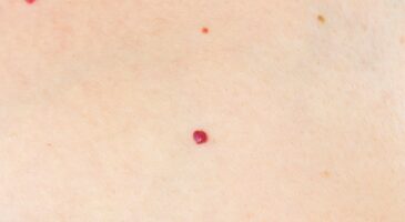 C'est quoi ces petits points rouges sur la peau ? L'avis d'un dermatologue s'impose dans ce cas précis