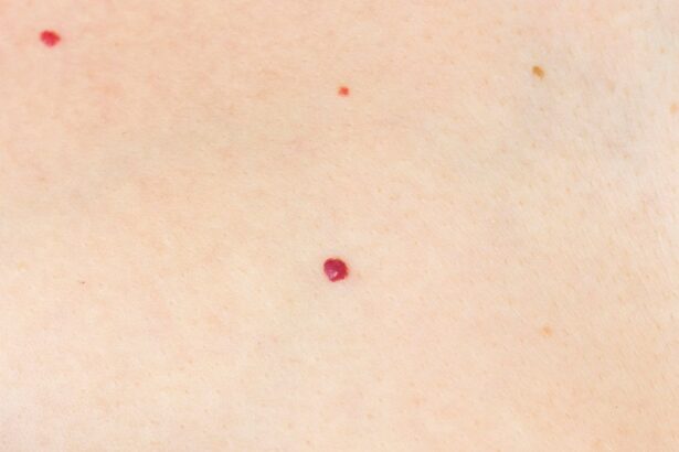 angiome point rouge peau